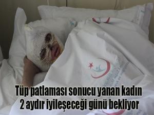 Tüp patlaması sonucu yanan kadın 2 aydır iyileşeceği günü bekliyor